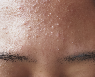 좁쌀여드름 이미지