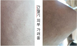 피부 가려움 증상