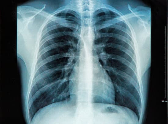 흉부 X선 촬영 (Chest X-ray): 개요, 목적 및 절차