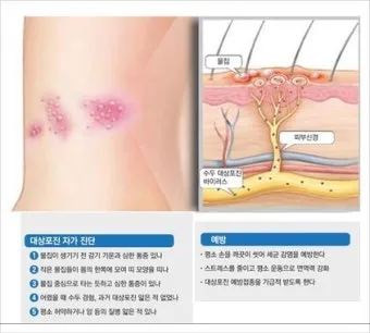 대상포진 치료방법에 대한 총정리 건강 질병관리_4