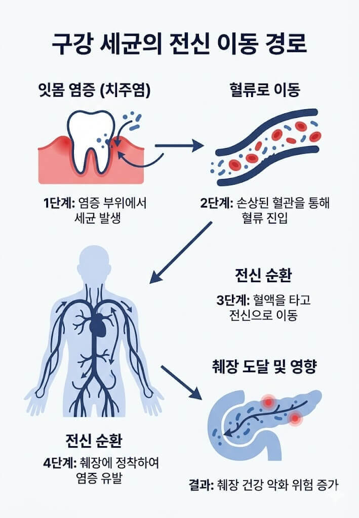 구강 세균의 전신 이동경로의 인포그래픽