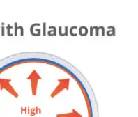 녹내장 초기 증상 &mdash; 시야를 서서히 빼앗는 침묵의 질환