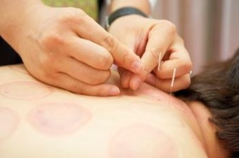 침 치료 vs 뜸 치료 차이 : 한의원 치료 방법 비교