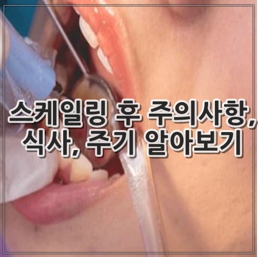 스케일링 후 주의사항, 식사, 주기 알아보기