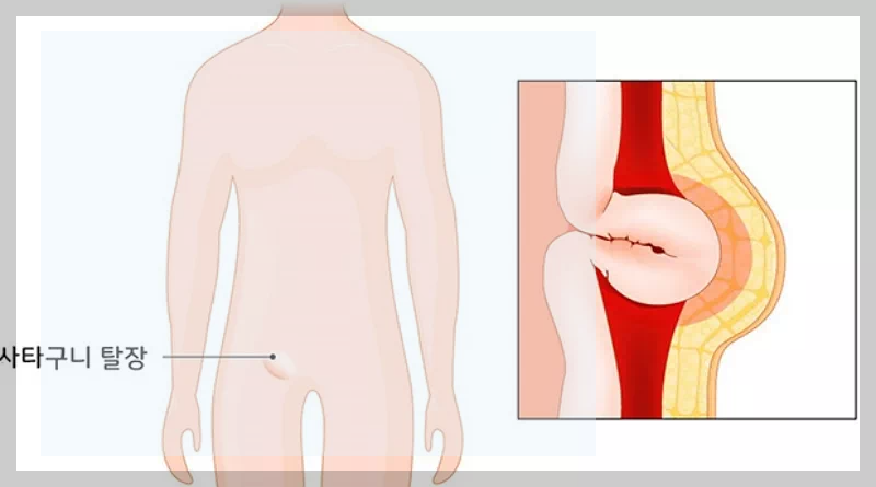 사타구니 탈장