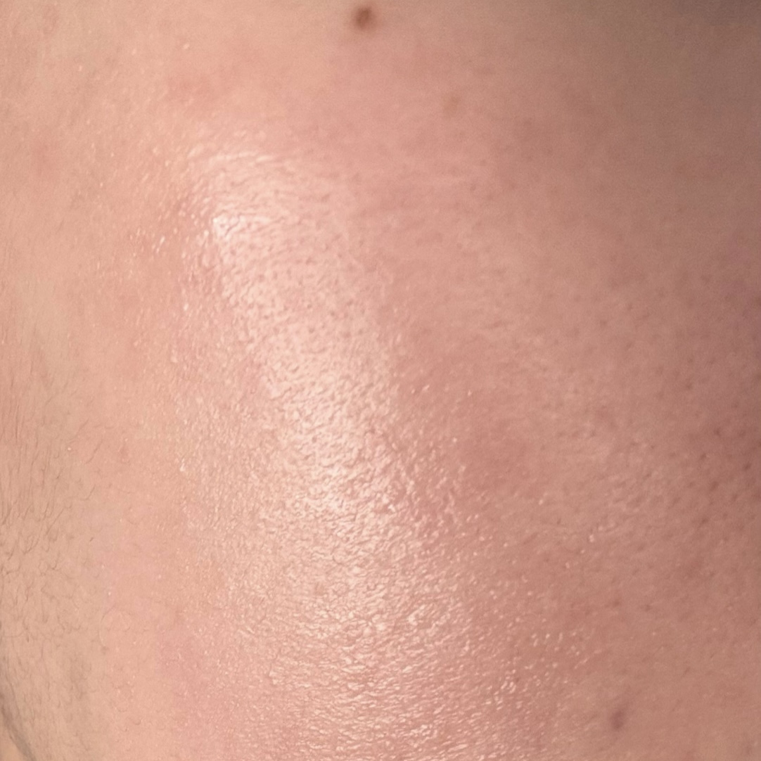 모낭염 완치 사진