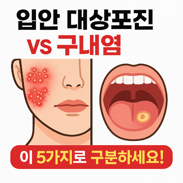 입안 대상포진 구내염 구분법 썸네일 이미지입니다.