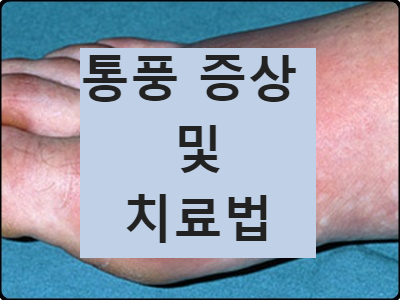발가락 통풍