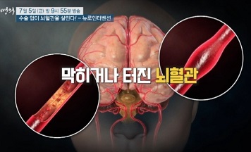 뇌혈관막힘
