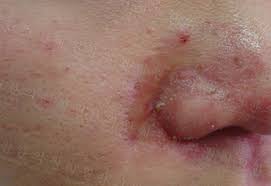 지루성 피부염 완치하려면