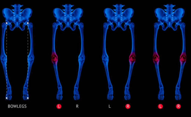 관절염의 4단계 진행 과정