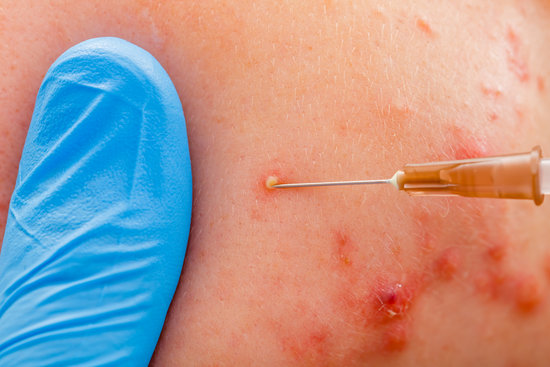 여드름 치료 약물 종류와 사용법