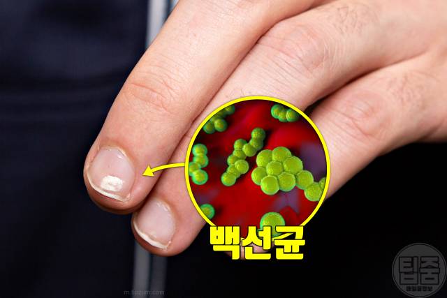 손톱 하얀 반점 손톱흰반점 손톱흰색가로줄 원인 손톱무좀 백선