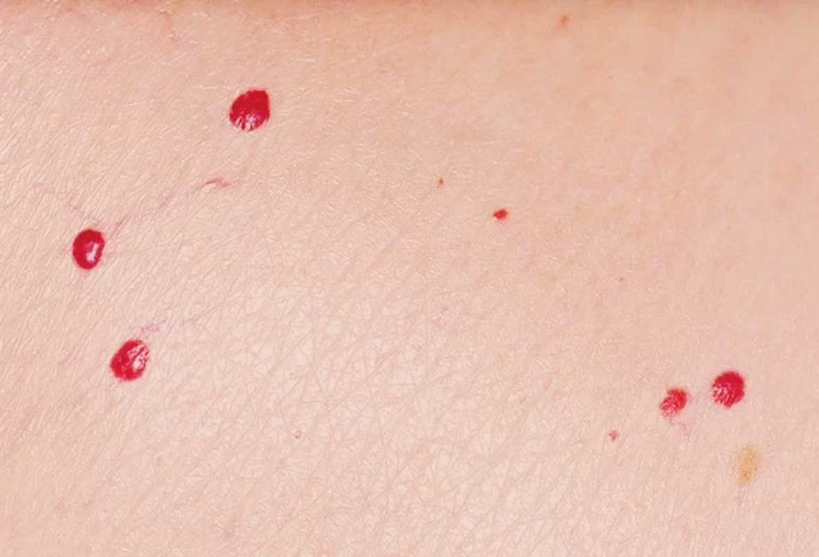 체리혈관종이란 원인과 제거 방법 사진