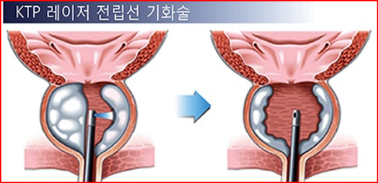 alt="KTP 레이저 수술"