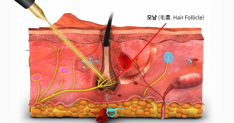 레이저 제모 원리