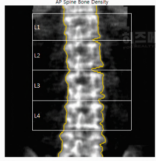 골다공증 수치보는법