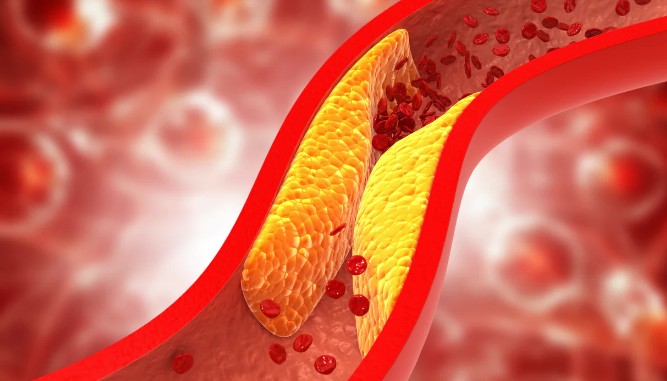 이상지질혈증의심증상 / 이상지질혈증 식이요법 / 이상지질혈증 검사 / 잔여 콜레스테롤