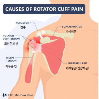 어깨통증원인