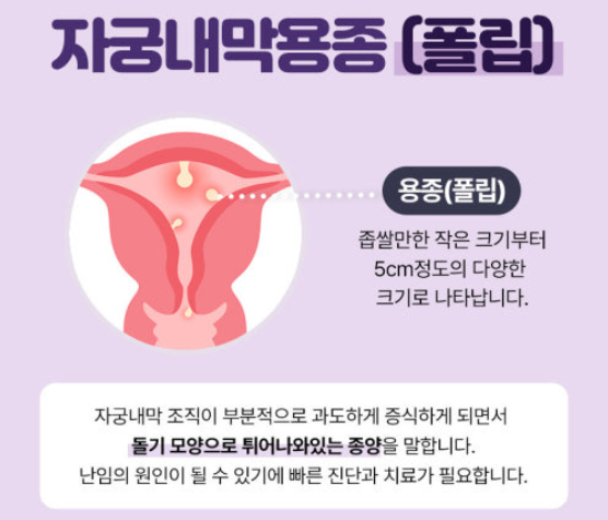 자궁내막폴립 관련 이미지