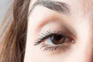 눈밑-지방재배치-회복기간