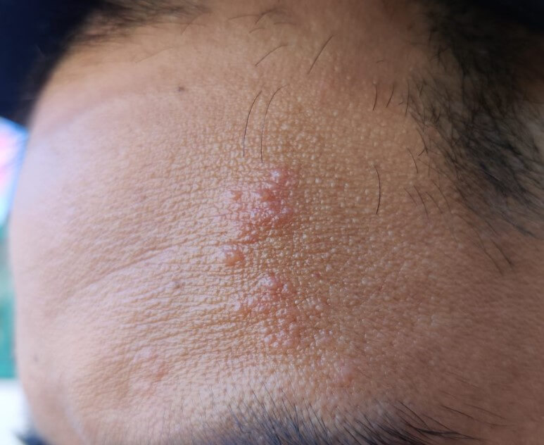 대상포진 초기증상 대상포진 조기치료 대상포진 초기증상 및 조기치료