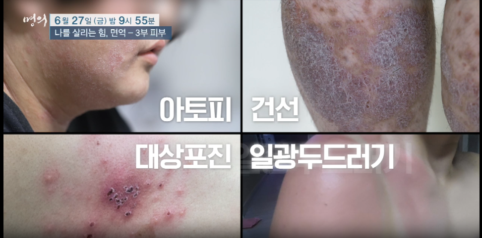 명의 나를살리는 힘 면역 3부 피부