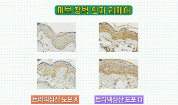 트라넥삼산 효능