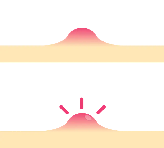사춘기 여드름 원인과 관리법