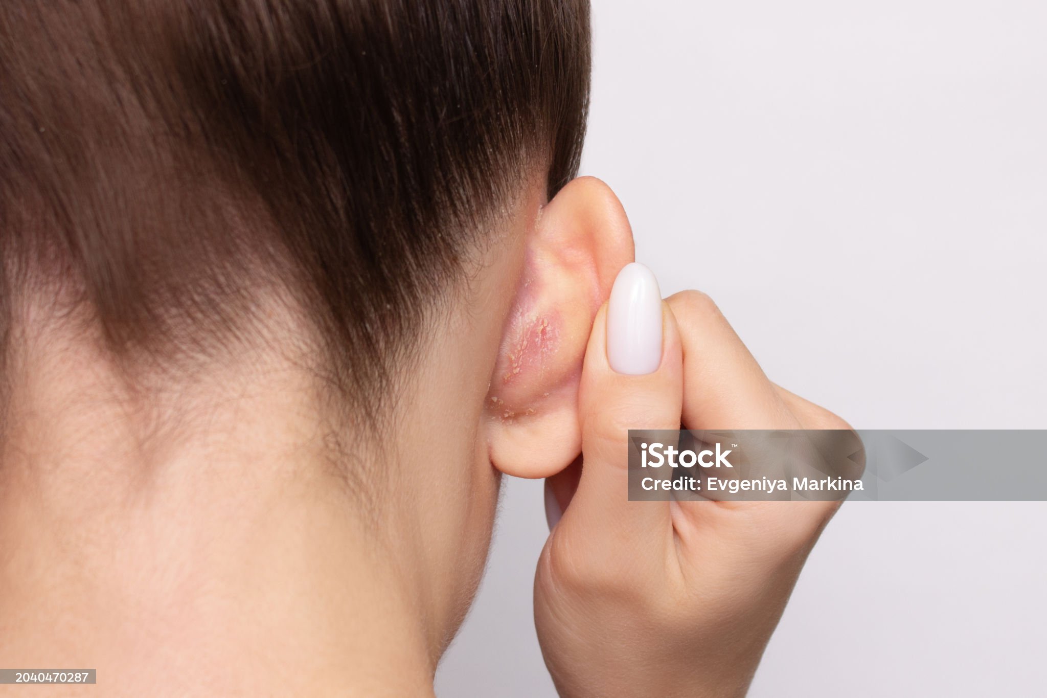 홍역의 피부 발진: 진행 과정과 특징 분석