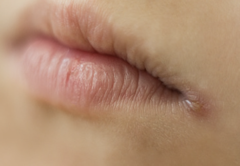 입술에 물집이 생기는 이유 8