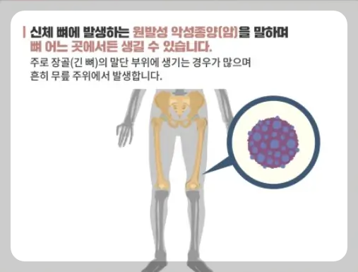 골육종