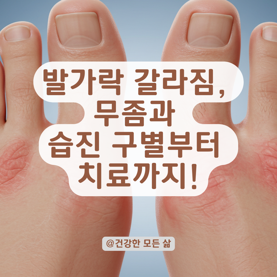 발가락 갈라짐이 계속된다면? 여기서 무좀인지 습진인지 구별부터 하세요.