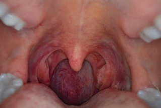 입냄새 원인 편도 결석