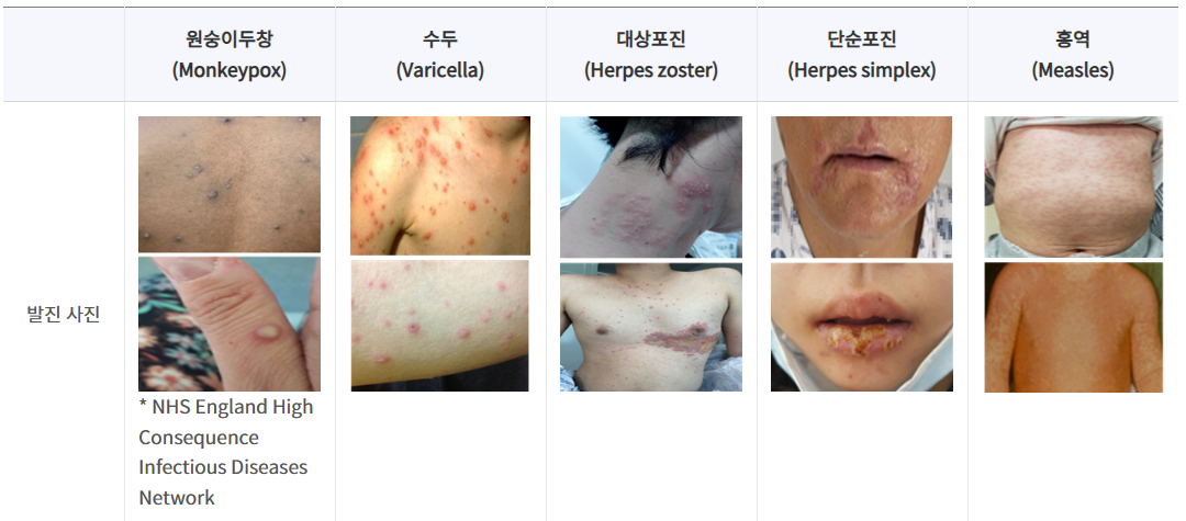 엠폭스원수이두창
