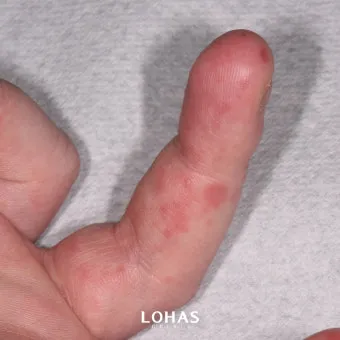 수족구 초기 증상 어른 감염 격리기간 예방 치료 완전 가이드_15