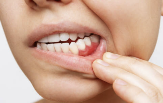 염증에 좋은 음식 6가지