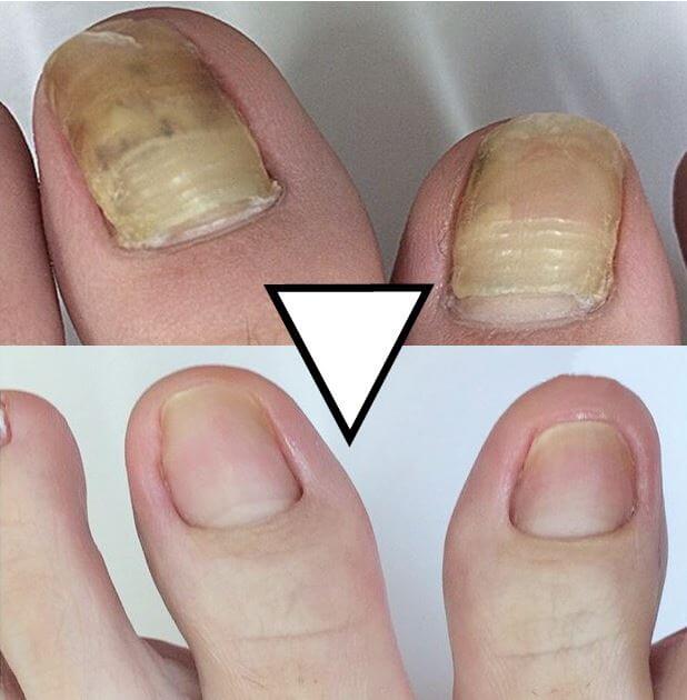 발톱 무좀 치료 후 호전 상태