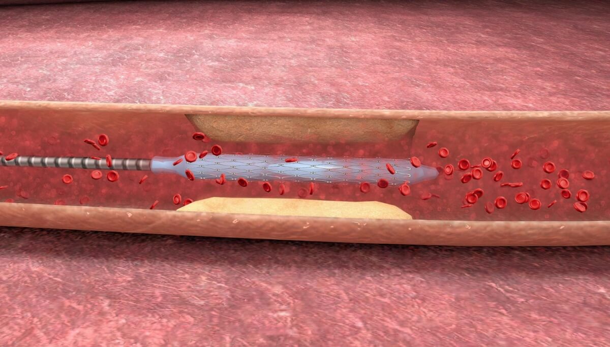 스텐트시술을-받은-혈관