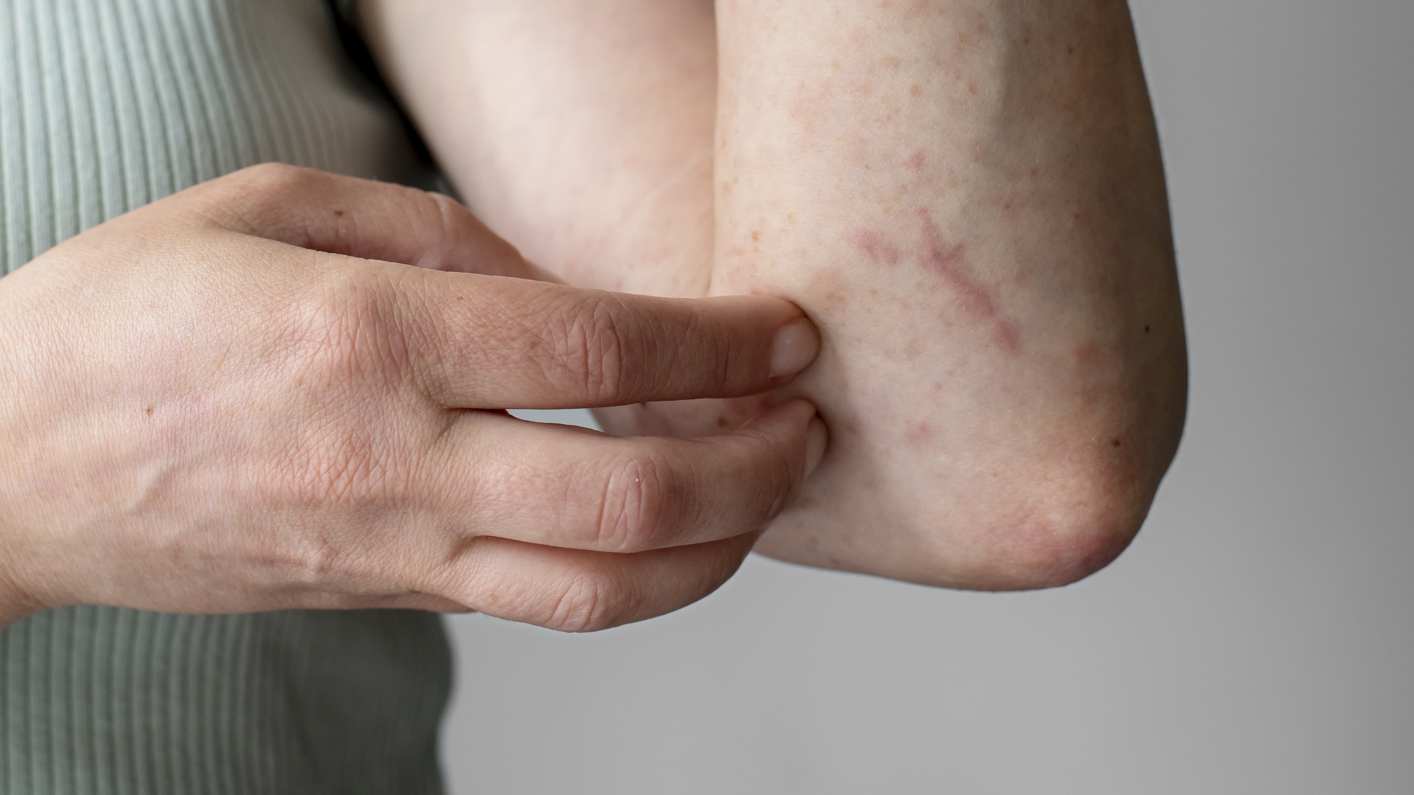 아토피 피부염의 근본 원인과 최신 치료 트렌드