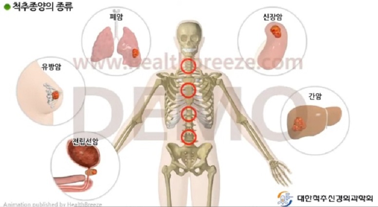 척수척추종양-명의-김치헌교수