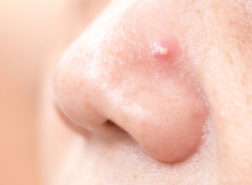 화농성 여드름 증상