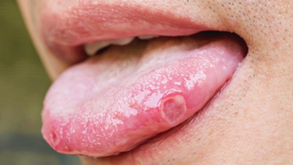 혓바늘이 돋는 이유 원인과 혓바늘 없애는 방법 꿀 치료법 자주돋는 현상 