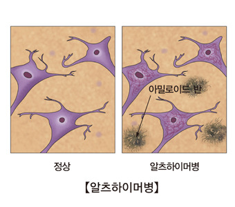 치매-알츠하이머-파킨슨병-차이점-치료-센터-리스트
