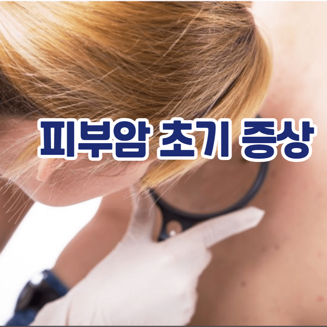 피부암 초기증상 흑색종