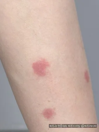 모기 물려 가려울 때 땀띠에 안티푸라민 연고 효능 부작용 사용후기_7