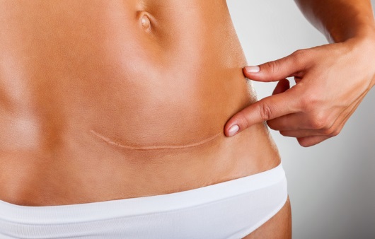 제왕절개