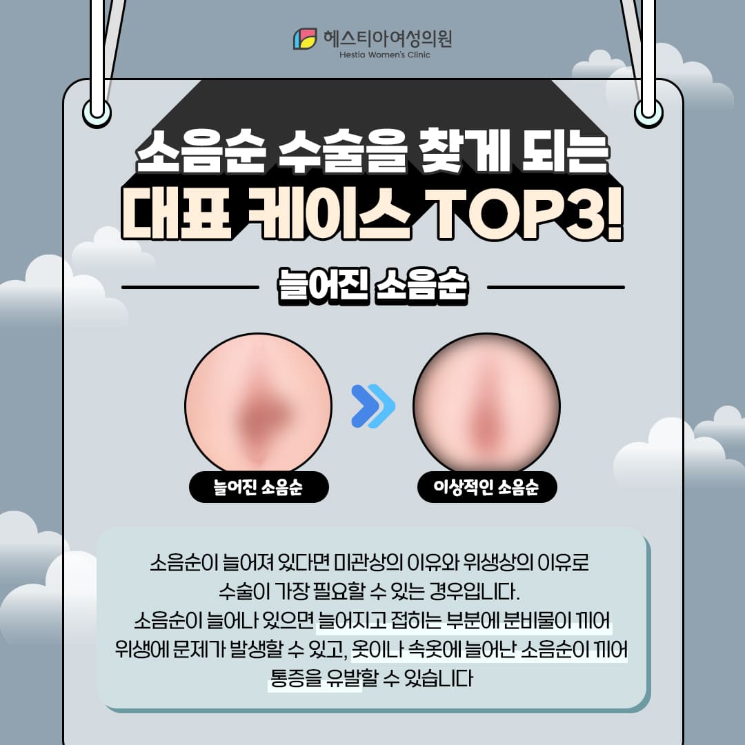 소음순수술을 찾는 소음순변형 세번째 : 늘어진소음순