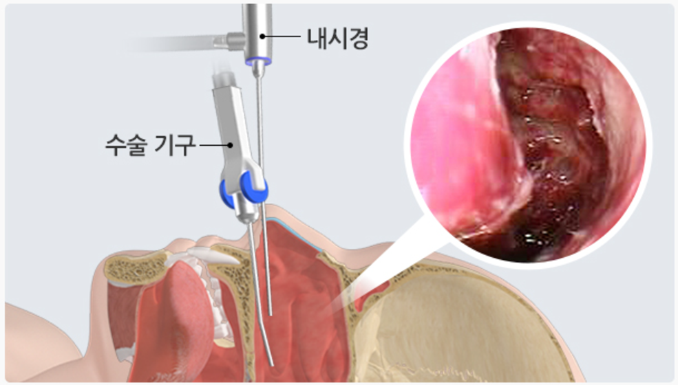 부비동염 내시경 수술