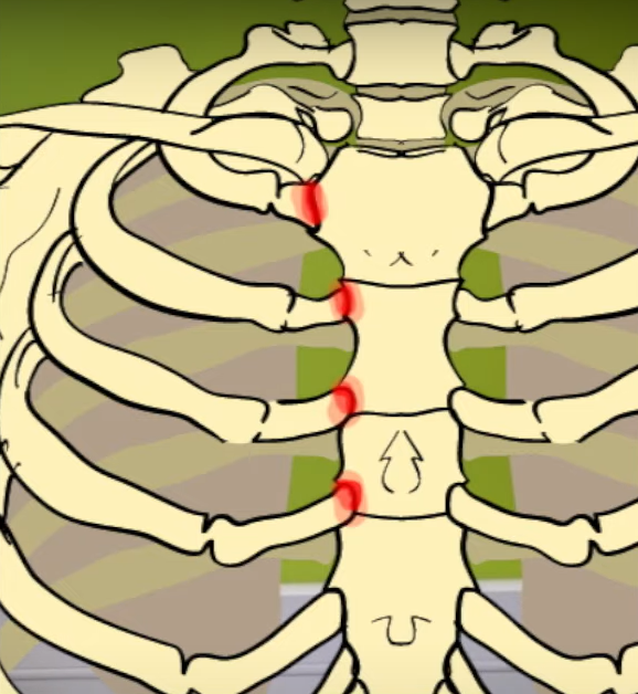 늑연골염 이미지